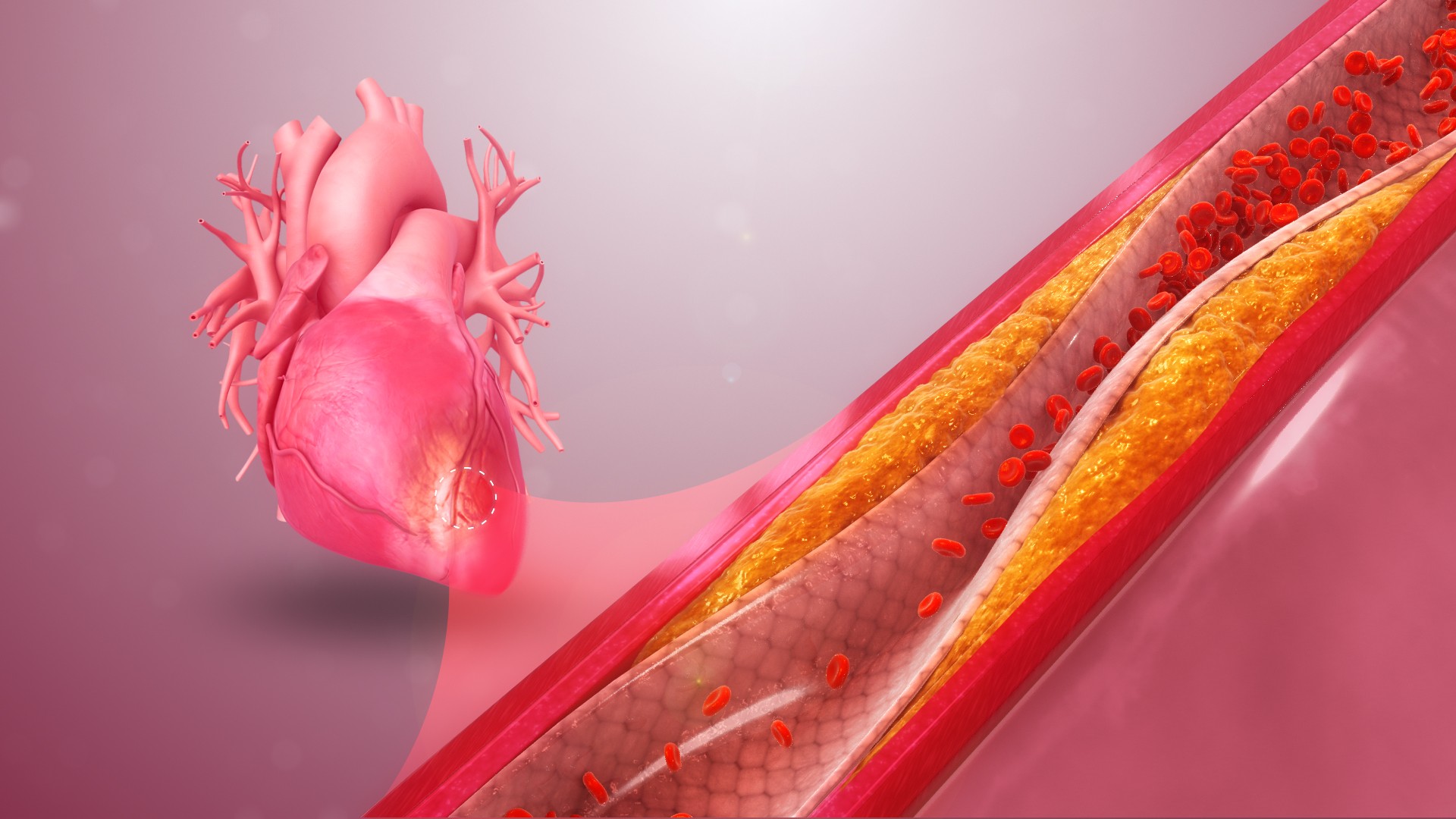 Medical illustration of a heart beside a cutaway coronary artery narrowed by atherosclerotic plaque.