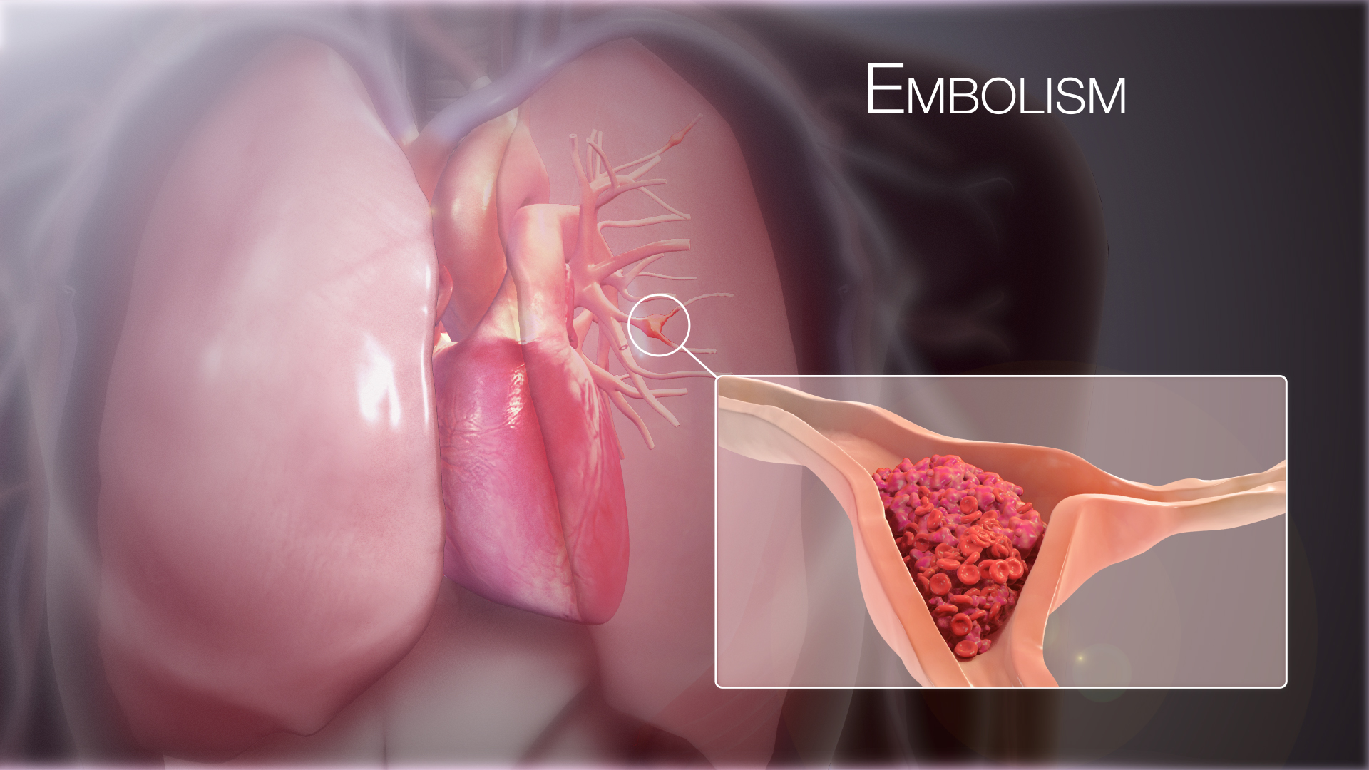 Medical illustration of a pulmonary embolus obstructing a branch of the lung circulation.