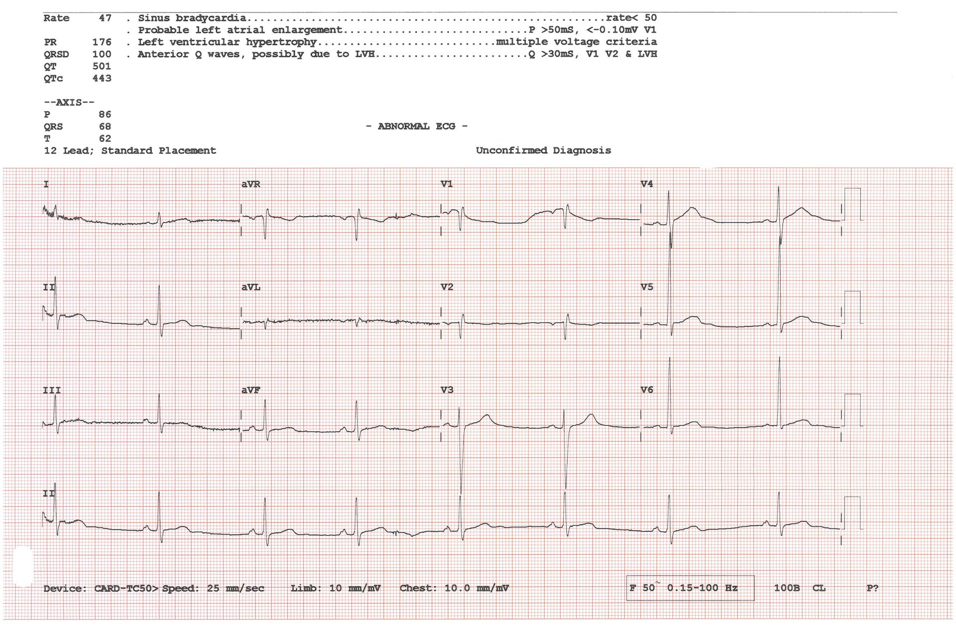 A clinical 12-lead ECG printout with black electrical waveforms on a red measurement grid.